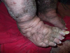 ugliest-feet-ever